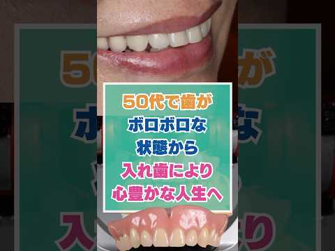 50代で歯がボロボロな状態から入れ歯により心豊かな人生へ