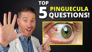 Yellow Spot On Your Eye (Pinguecula) - Top 5 Questions Answered!