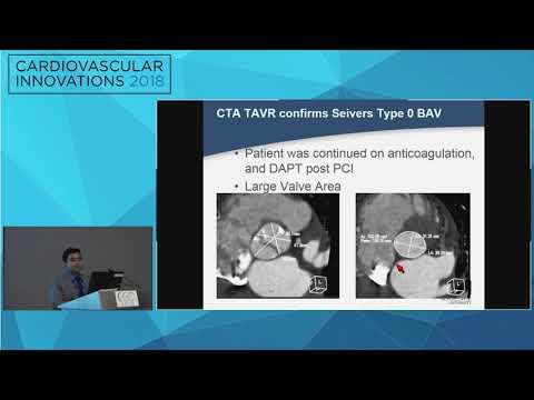 CVI2018 Session: A Challenging Case of Bicuspid Aortic Stenosis - Allen C. Rassa MD