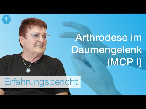 #4 Erfahrungsbericht Arthrodese im Daumengrundgelenk (MCP I)
