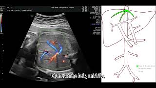 Asvide: Demonstration of the “five-plane method” for diagnosing CEPSs in fetuses, including...
