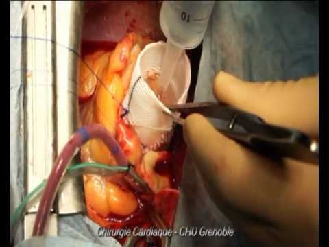 Wymiana opuszki aorty z zachowaniem zastawki aortalnej