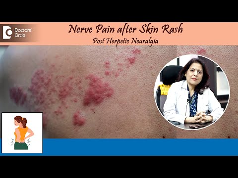 NERVE PAIN AFTER SKIN RASH?| Post Herpetic Neuralgia | Herpes Zoster-Dr.Swati Bhat | Doctors' Circle