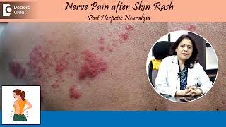 NERVE PAIN AFTER SKIN RASH?| Post Herpetic Neuralgia | Herpes Zoster-Dr.Swati Bhat | Doctors