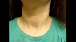 Thyroid Nodule Mass - Later Found To Be Cancer