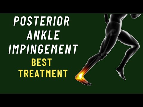 Posterior Ankle Impingement Exercises | Os Trigonum Treatment