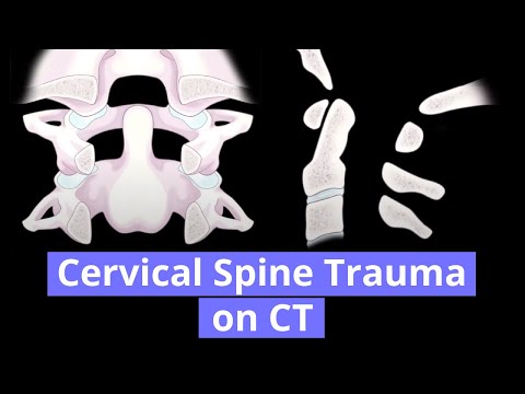 Cervical Spine Trauma on CT