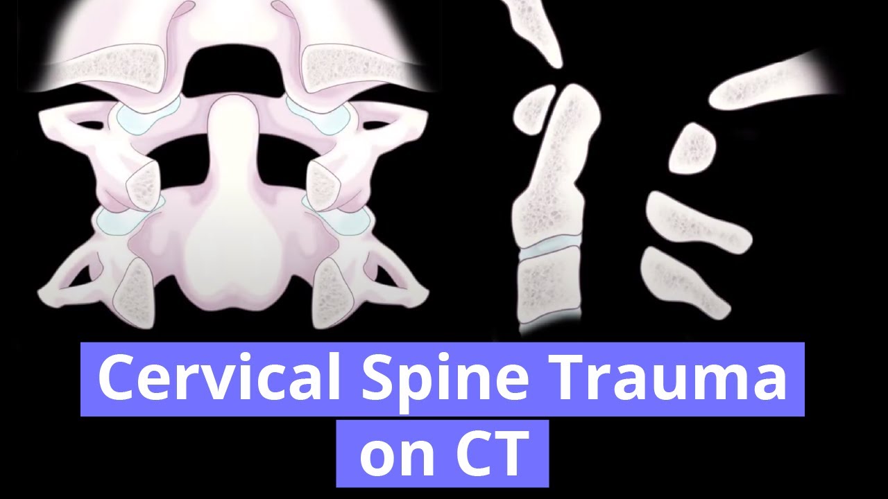 Cervical Spine Trauma