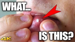 Mysterious Zit/Pimple On Lip (Gross Close-Up Popping in 4K)
