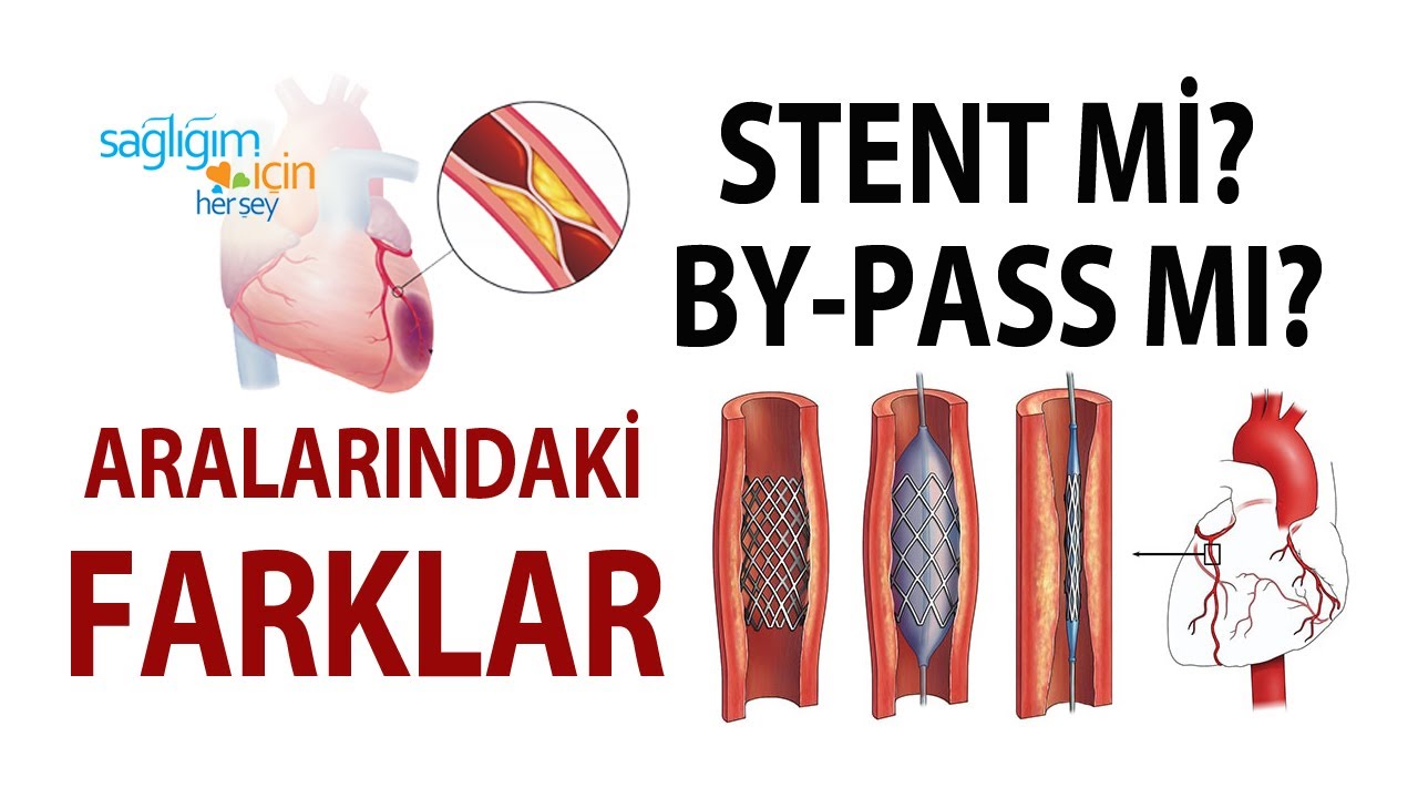 Stent mi Yoksa By-pass mı ?