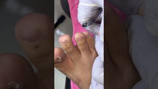 Ep_8841 Ingrown toenail removal 👣 เจ็บแล้วจะได้หาย..รีบมาหาพี่ 😅 (clip from Thailand)