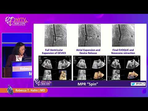 Advances in Imaging for Tricuspid Valve Intervention: Lessons Learned - Rebecca T Hahn, MD