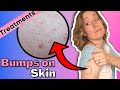 Red Bump on Your Arms | How to Treat Your Keratosis Pilaris at Home.