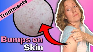 Red Bump on Your Arms | How to Treat Your Keratosis Pilaris at Home.