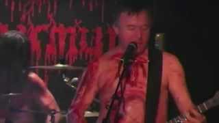 Disastrous Murmur Extra Uterine Pregnancy