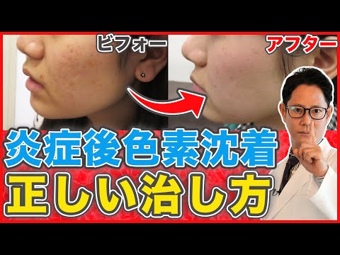 ニキビ跡を取り除く方法 – 軟膏と治療法