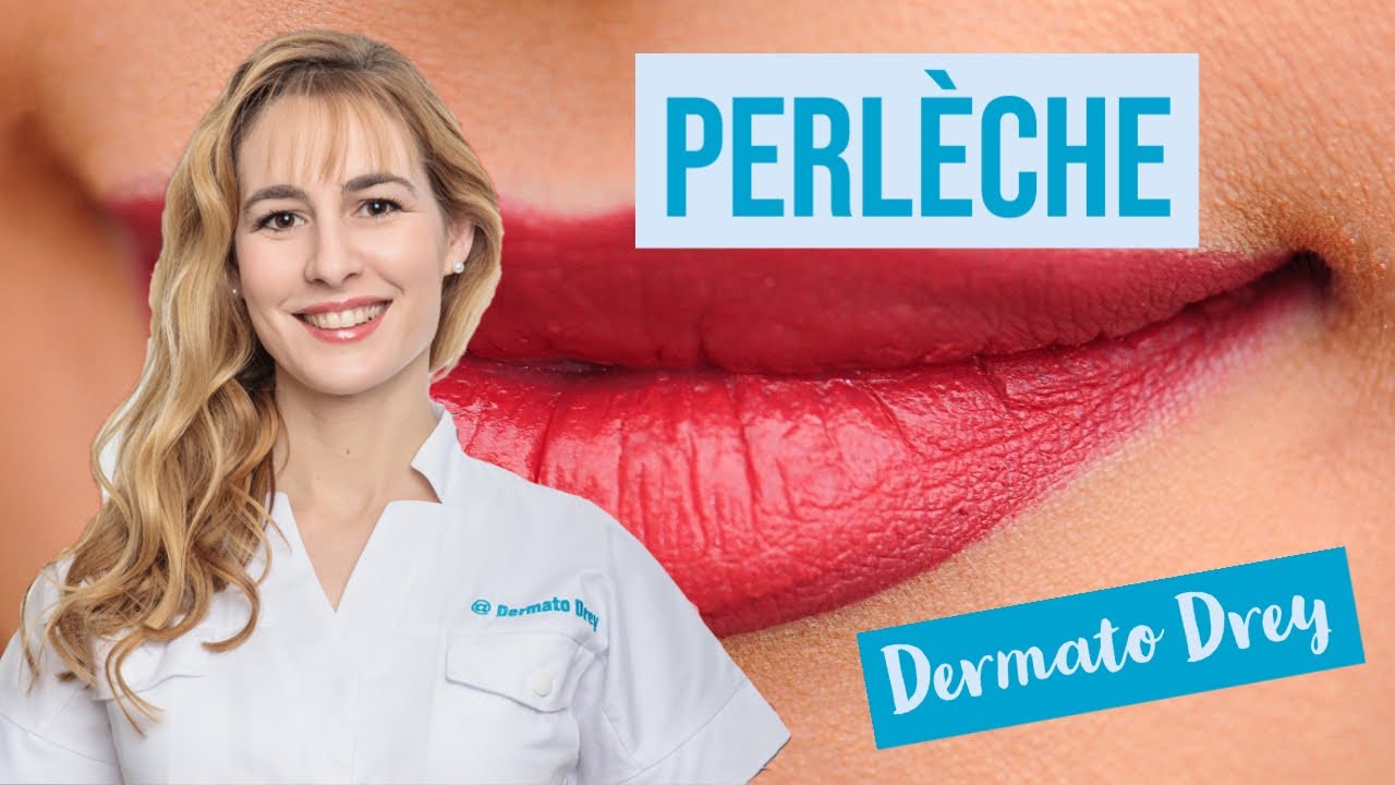 La perlèche, cette fissure au coin des lèvres ! #DermatoDrey