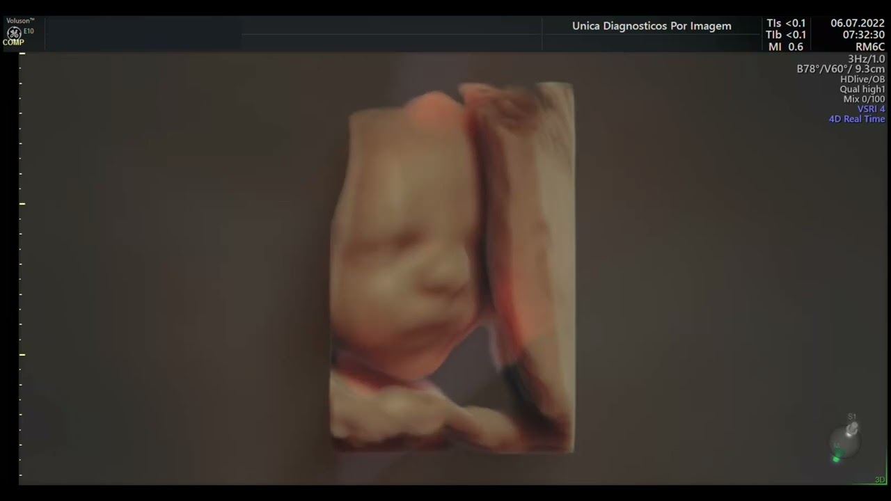 Ultrassom 4D HD Live - 01