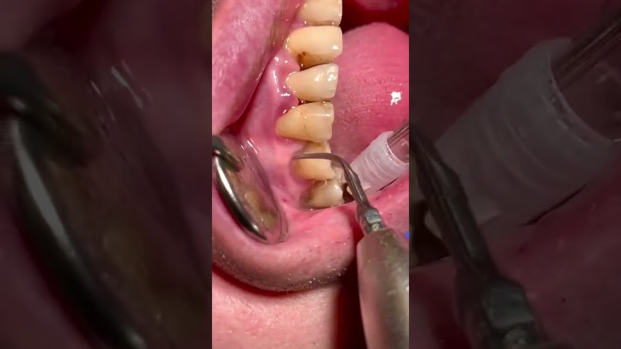 Igiene dentale profonda. Presenza di tasca parodontale ???? #dentist #dentista