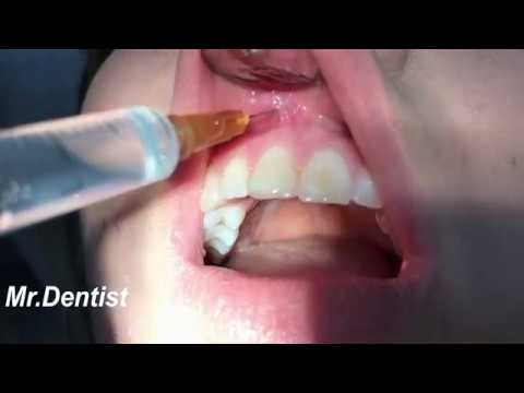 Dental Anesthesia Injection !