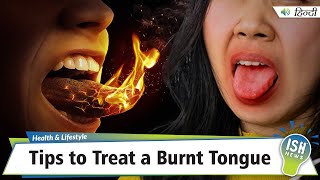 Tips to Treat a Burnt Tongue