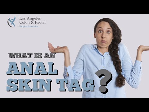 What Are Anal Skin Tags and Should You Remove Them?