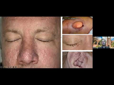 Global Dermatology Talks - 8/7/2023 - Neil Rajan