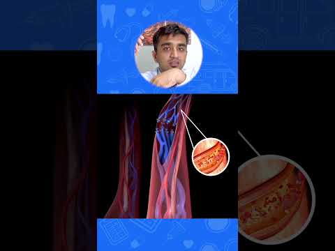 Varicocele Ka Ilaaj Surgery Se Kaise Hota Hai? | Surgical Treatment For Varicocele