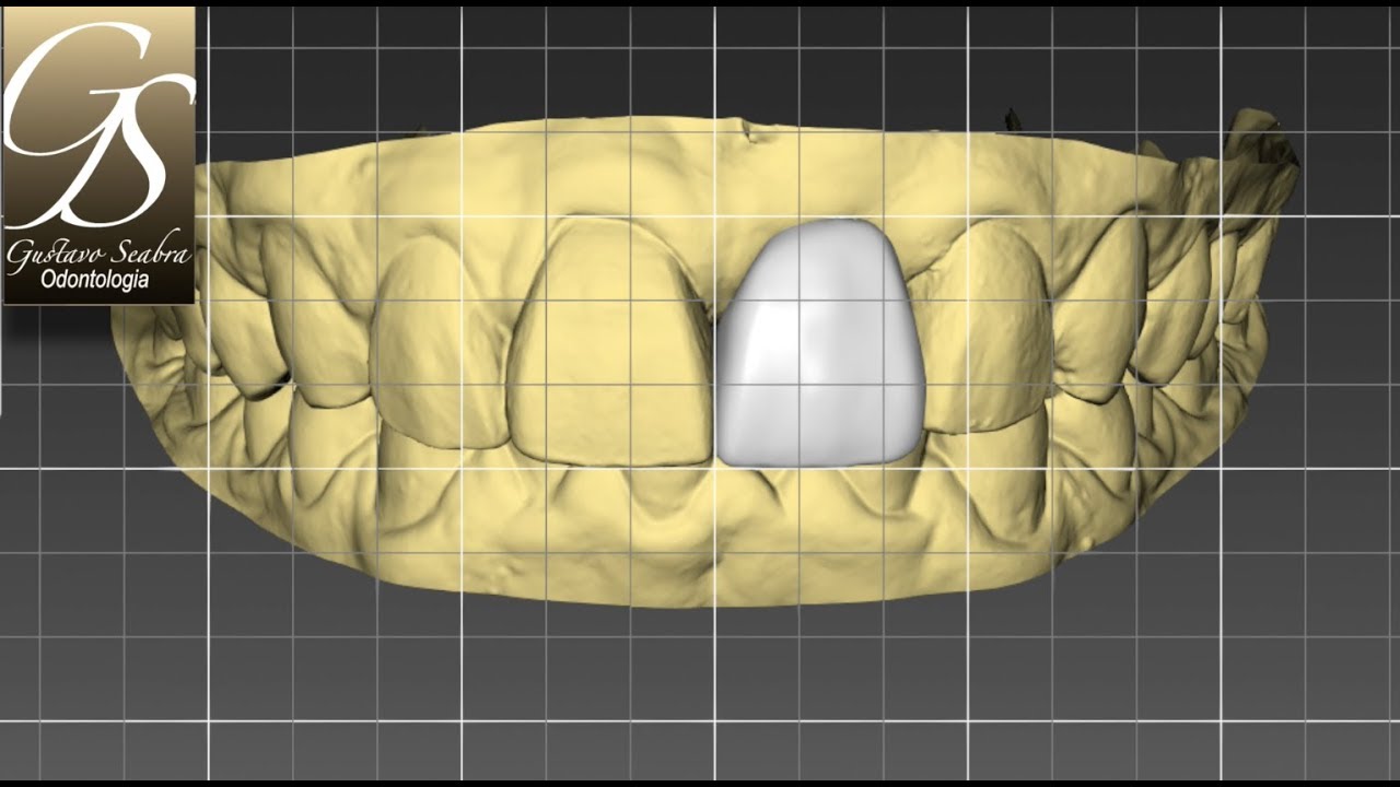 Fluxo Digital - Cerec In Lab - Caso Unitário - Referência Biogenérica