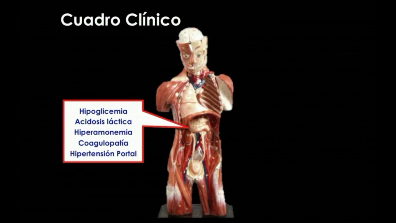 Falla hepatica aguda #FOAMed #MUE #ChileEM