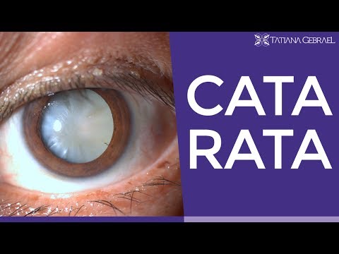 Cataratas: Assista a este vídeo antes da cirurgia!