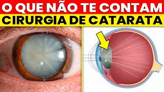 Cirurgia de Catarata: O Lado BOM e o Lado RUIM que NINGUÉM te CONTA