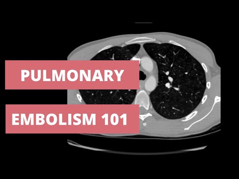 How to Identify a Pulmonary Embolism on CT - Search Pattern for CTA chest