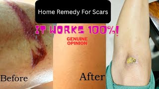 HOW TO REMOVE OLD SCARS FROM LEGS & FACE - Natural Scar Removal