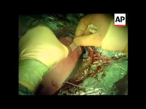 New 3D technique helps treat babies with heart defects