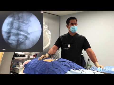 Radiofrequency Ablation Procedure