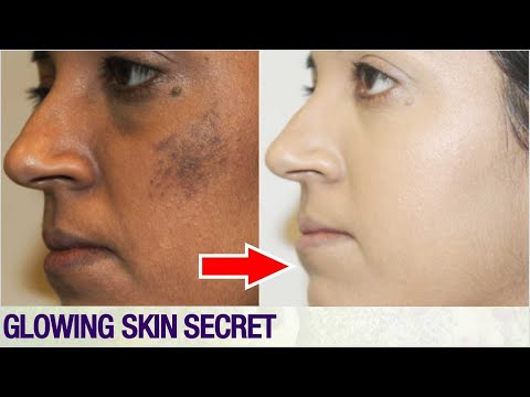 साफ़ त्वचा पाने के 2 आसन उपाय | How to Get Fair & Spotless Skin in Naturally Video