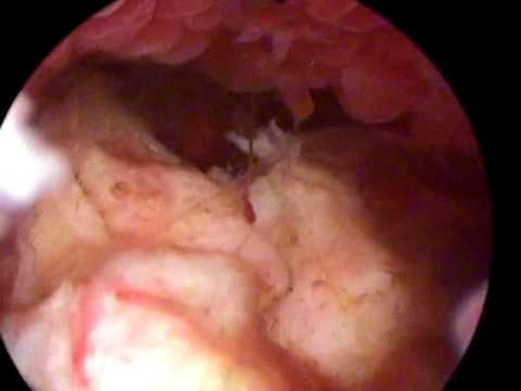 comment soigner fibrome