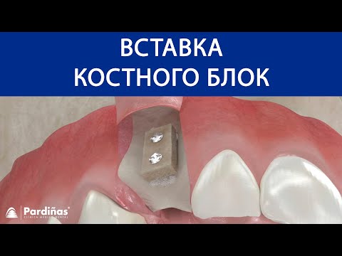 Вставка костного блока ©