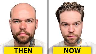I Got A Turkish Hair Transplant! | Hair Surgeon Reacts