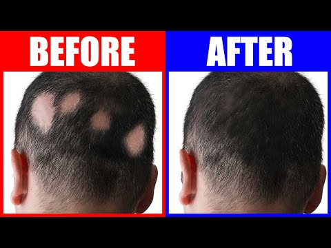 How To Naturally Reverse Premature Graying of Hair