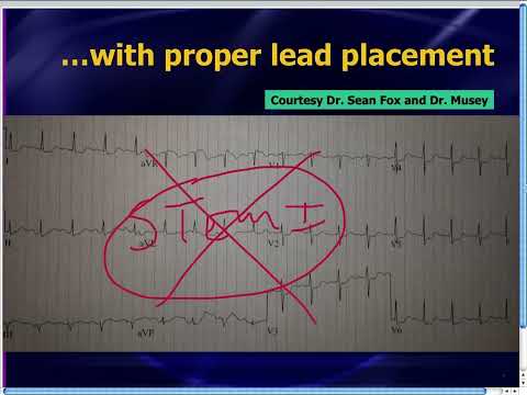 Amal Mattu's ECG Case of the Week_ Oct 21, 2013