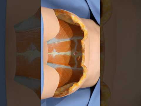 How a tummy tuck removes excess skin (3D Animation)