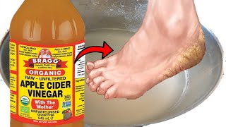 How To Get Rid of Dead Skin, Calluses, Foot Odor and Fungus on Feet Using Apple Cider Vinegar