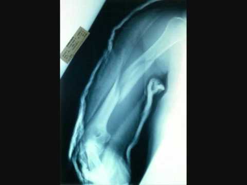 Video thumbnail for Break Your Arm