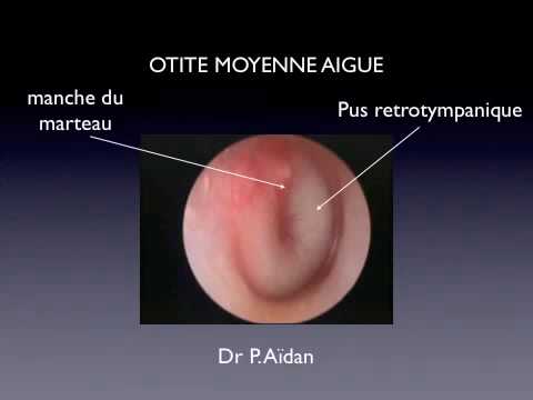 comment traiter une otite moyenne