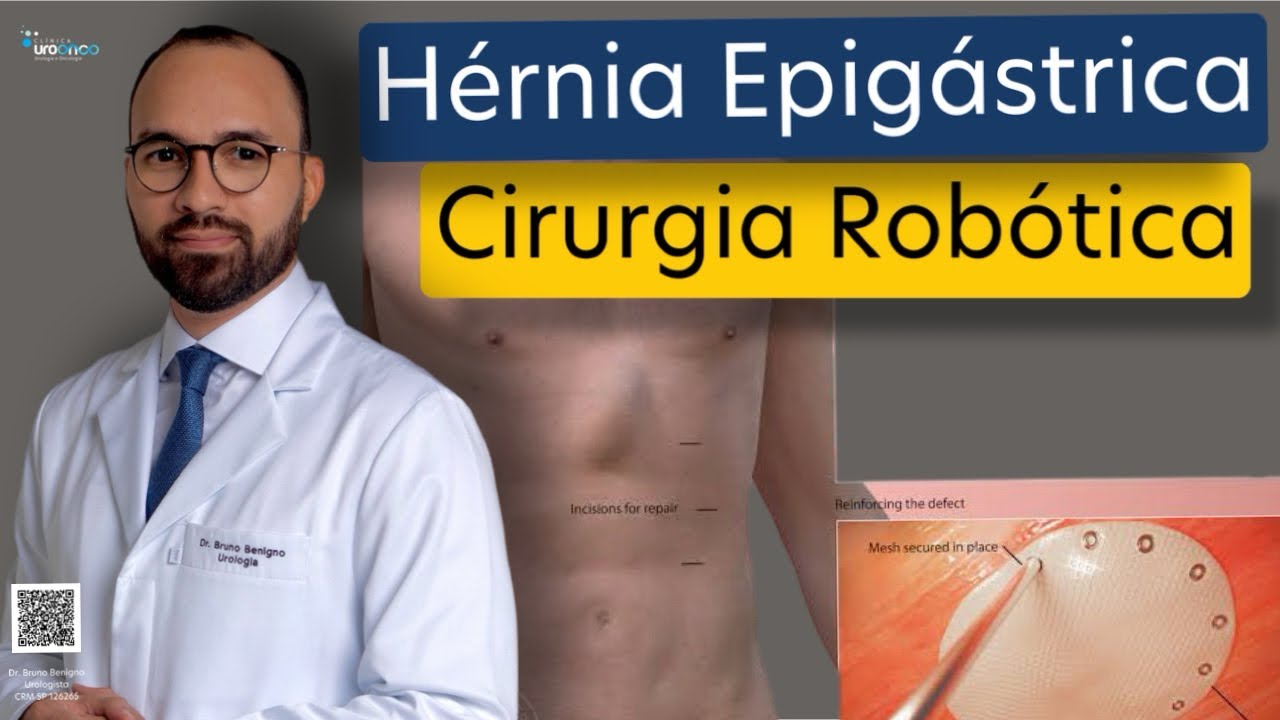 Hérnia Epigástrica e Diástase Abdominal | Tratamento com Cirurgia Robótica | Aula para Pacientes
