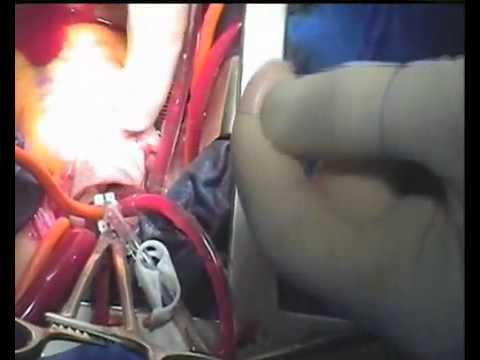 Elettromagnete nel trattamento delle articolazioni Come curare colonna cervicale dai depositi di sale