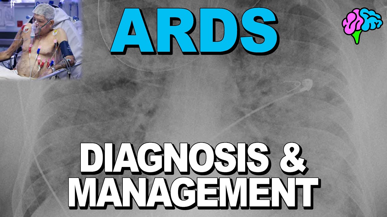 Diagnosis and Management of Acute Respiratory Distress Syndrome (ARDS)