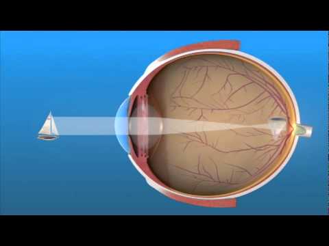 A látás trombózisa